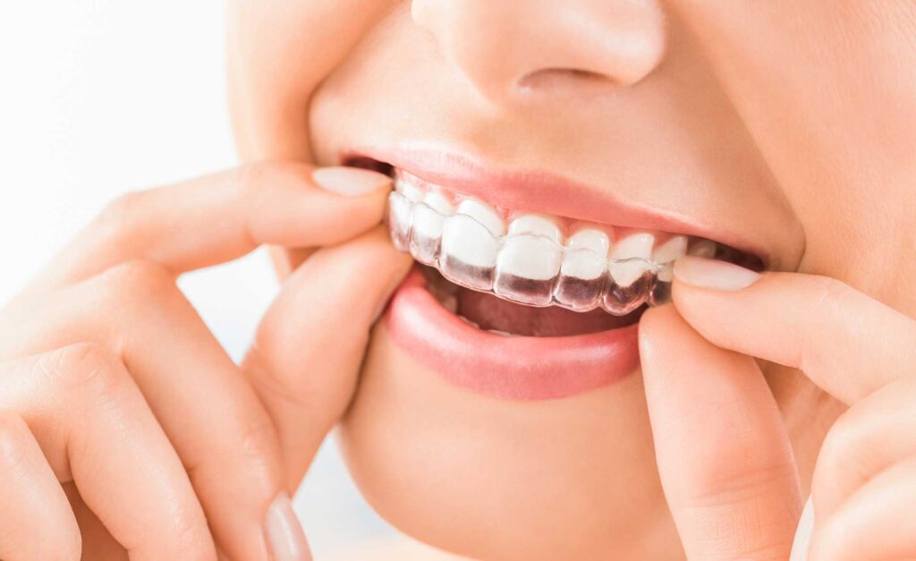 Ortodonzia Invisibile – Studi dentistici Curreli – dentista Cagliari Selargius Vallermosa
