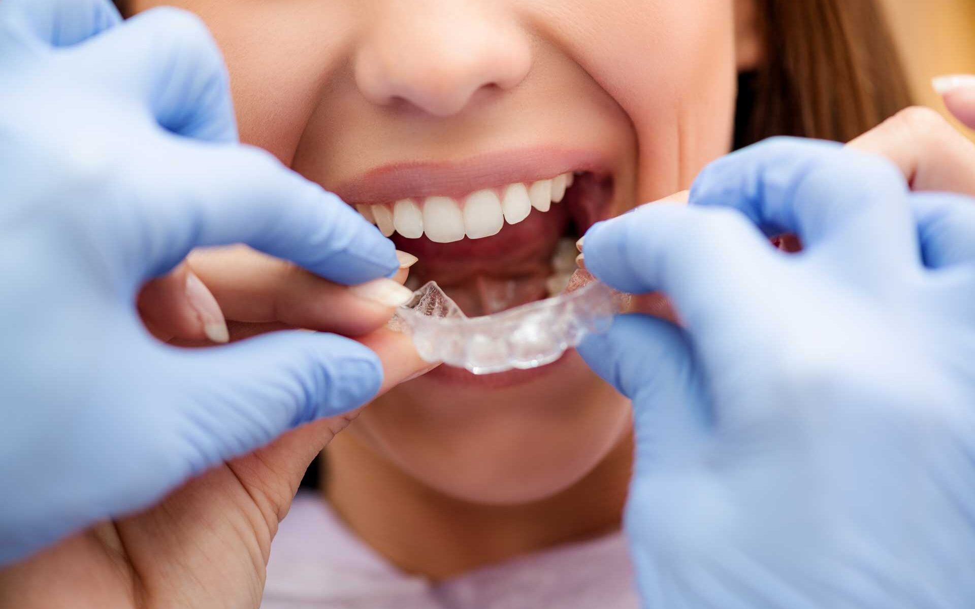 Ortodonzia Invisibile - Studi dentistici Curreli - dentista Cagliari Selargius Vallermosa